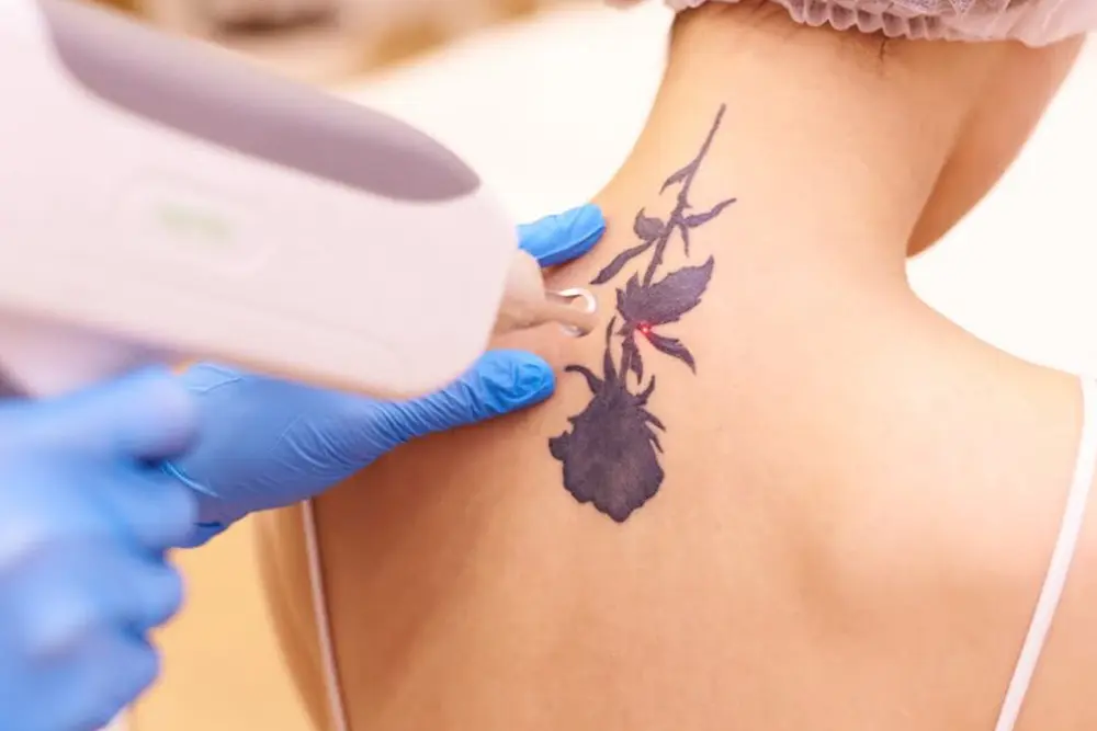 Laser Tattoo Removal San Antonio DaVida Medical & Aesthetics