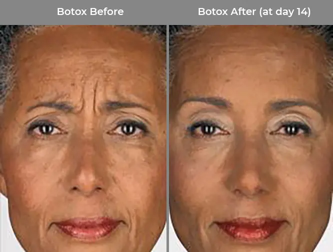 Botox Before & After