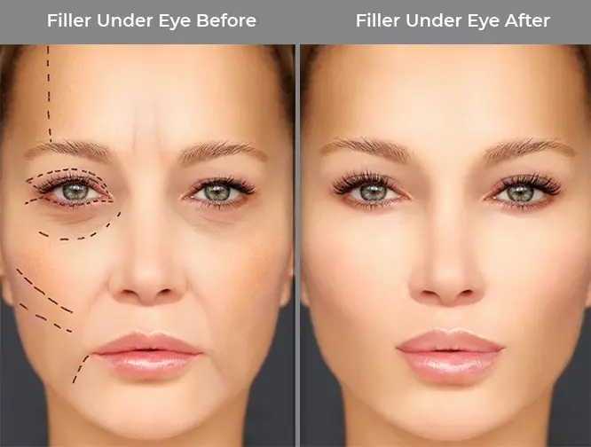 Under Eye Filler Treatment Before & After