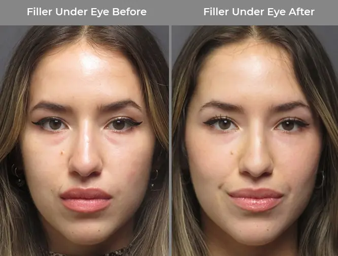 Under Eye Treatment Before & After