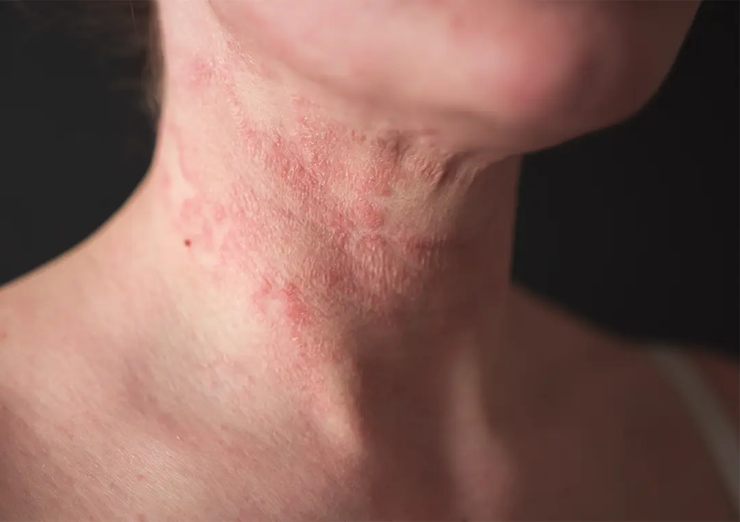 Eczema Treatments San Antonio | DaVida Medical & Aesthetics