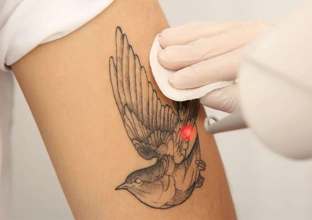 Laser Tattoo Removal San Antonio | DaVida Medical & Aesthetics