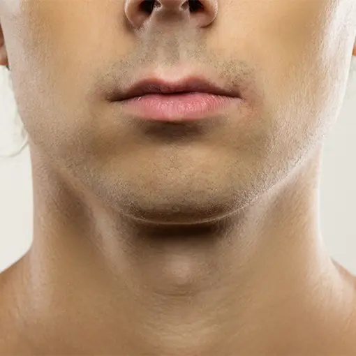 Kybella Male Aesthetic Services San Antonio | DaVida Medical & Aesthetics