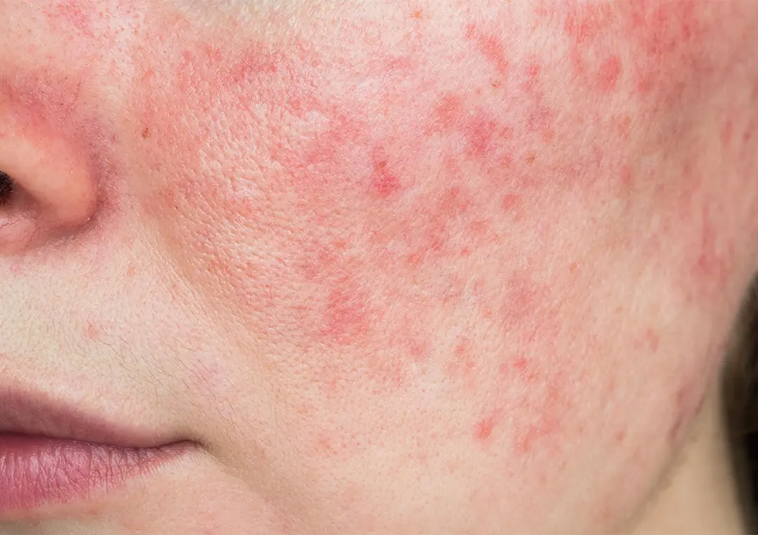 Rosacea