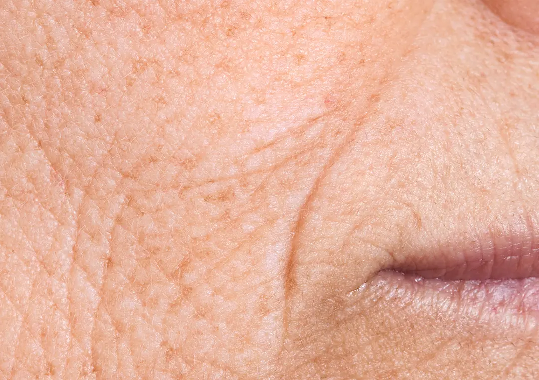 Skin Conditions Treated in San Antonio | DaVida Medical & Aesthetics