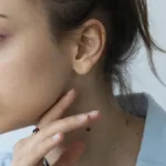 What Causes Skin Tags on the Neck?