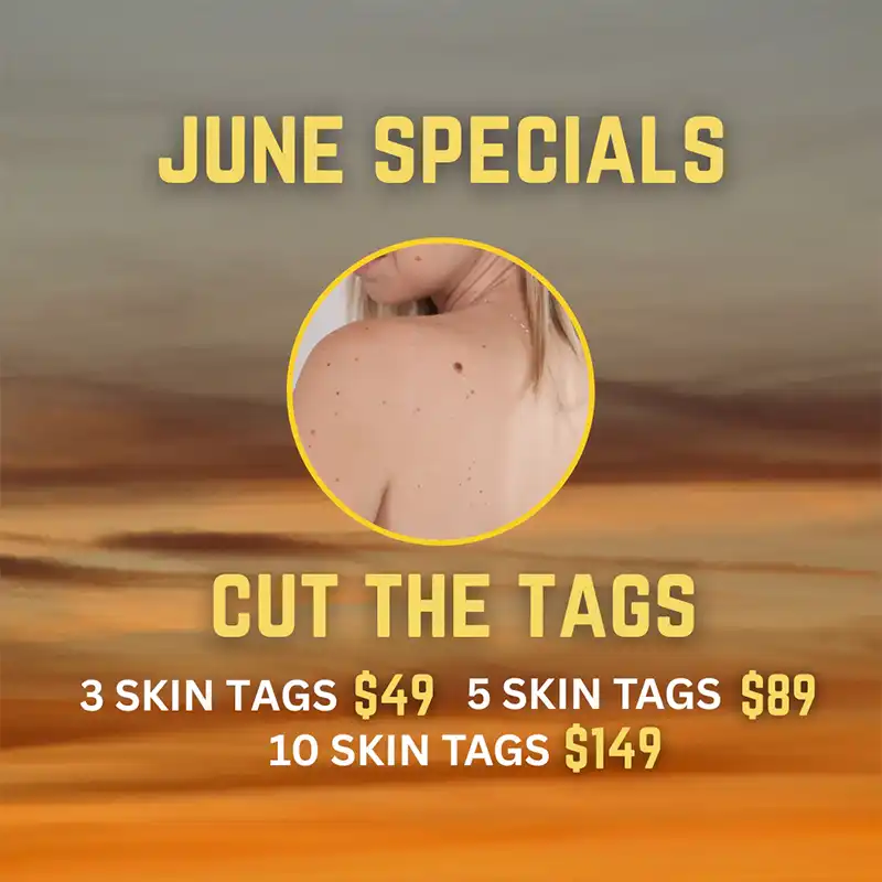 Skin Tag Removal Offer