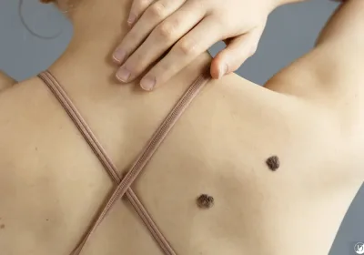 Full Skin Exam in San Antonio | DaVida Medical & Aesthetics