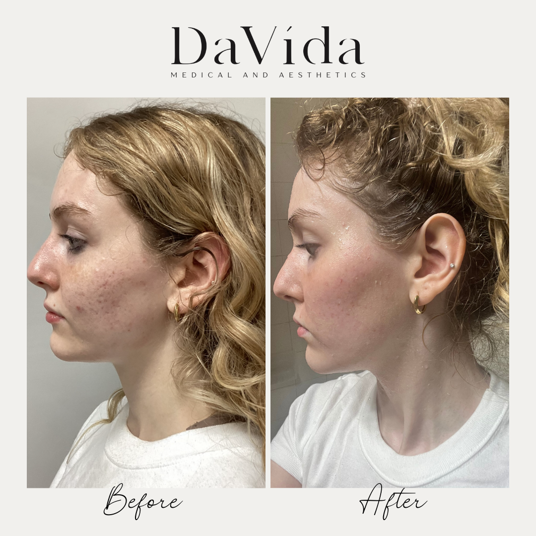 Treatments for Hyperpigmentation and Acne Scars