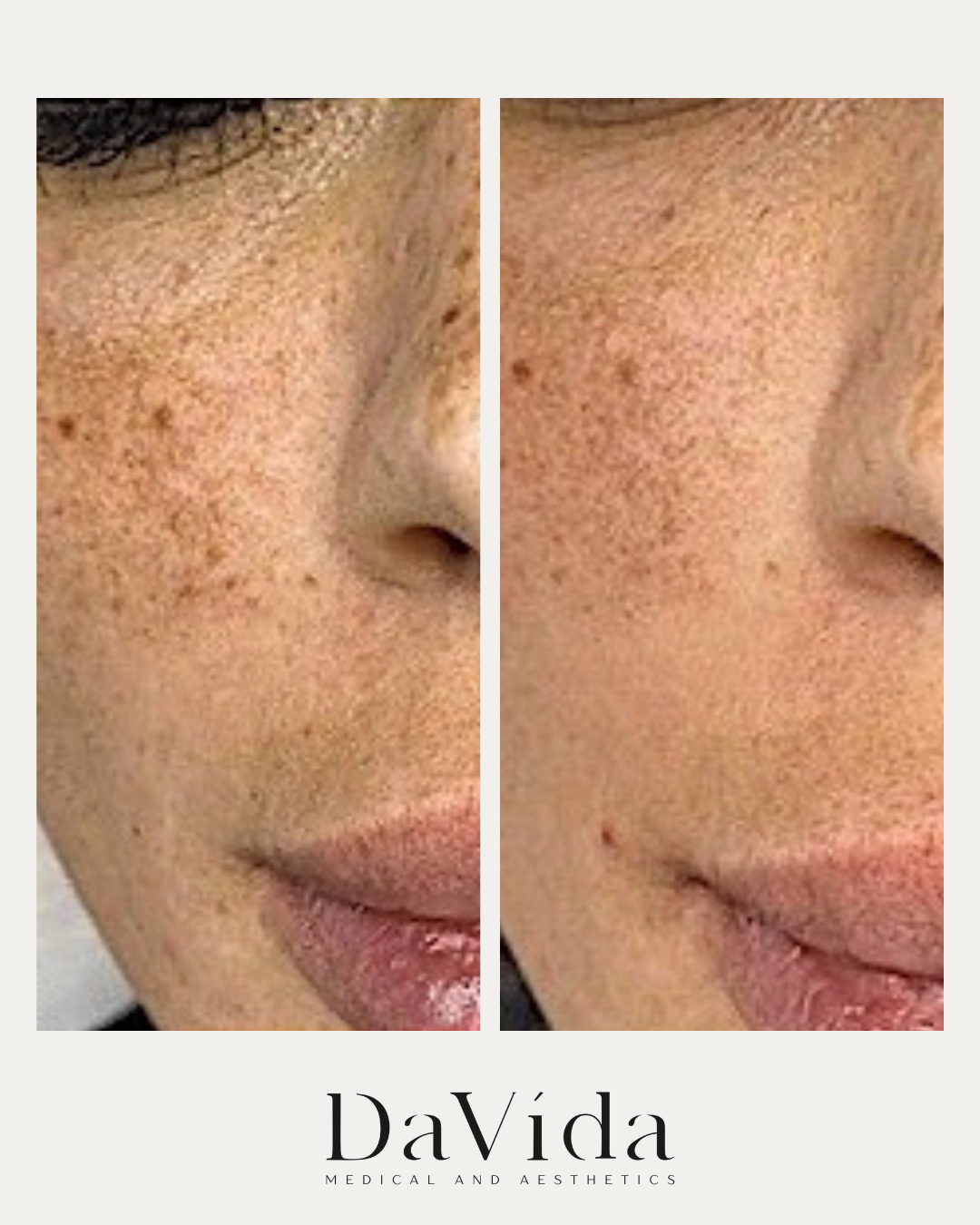Salicylic acid peel before and after on the face