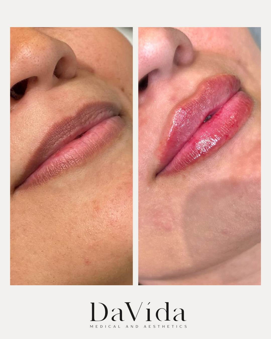 1 Syringe of Restylane Kysse Results at DaVida Medical and Aesthetics