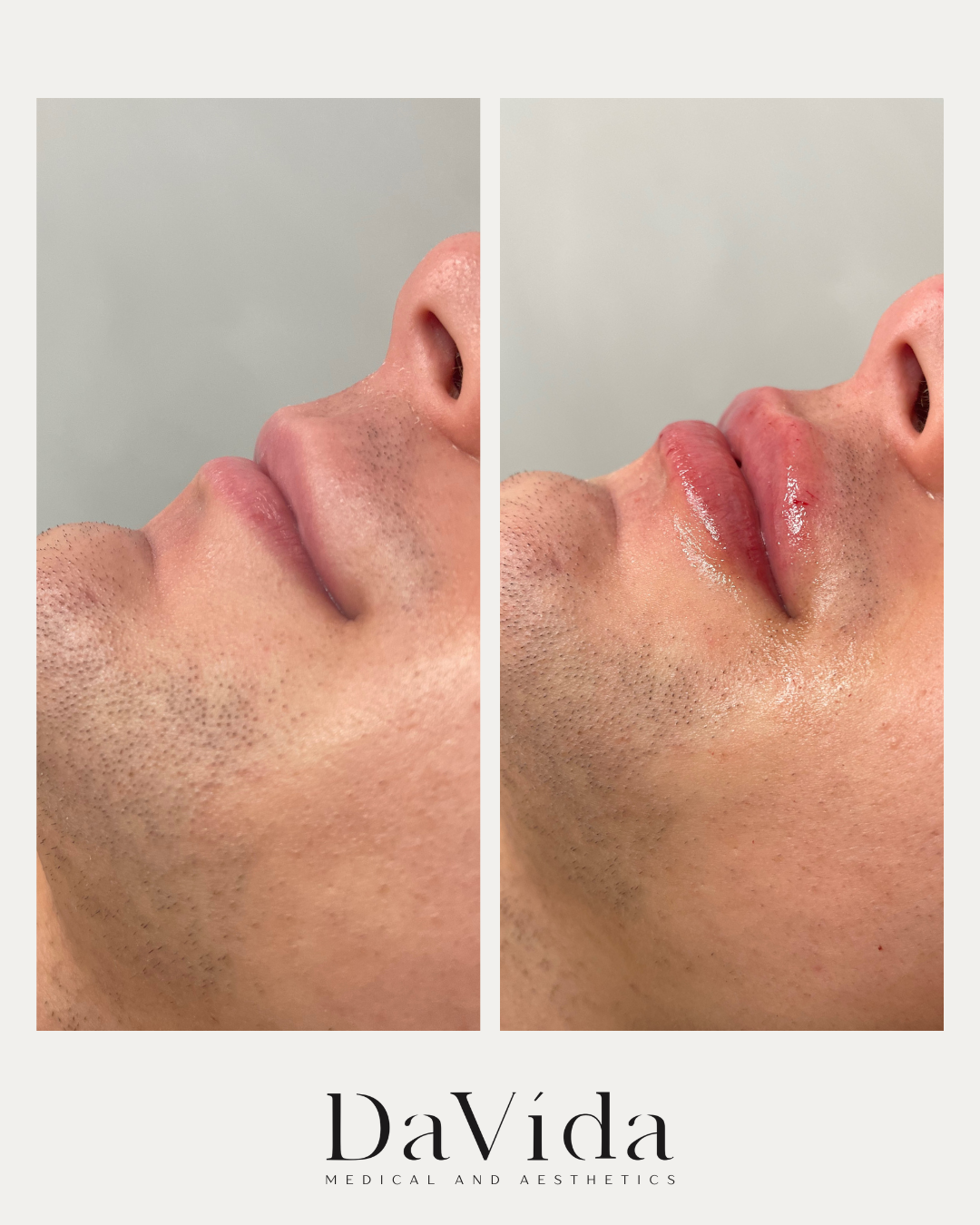 1 Syringe Juvederm Volbella Results