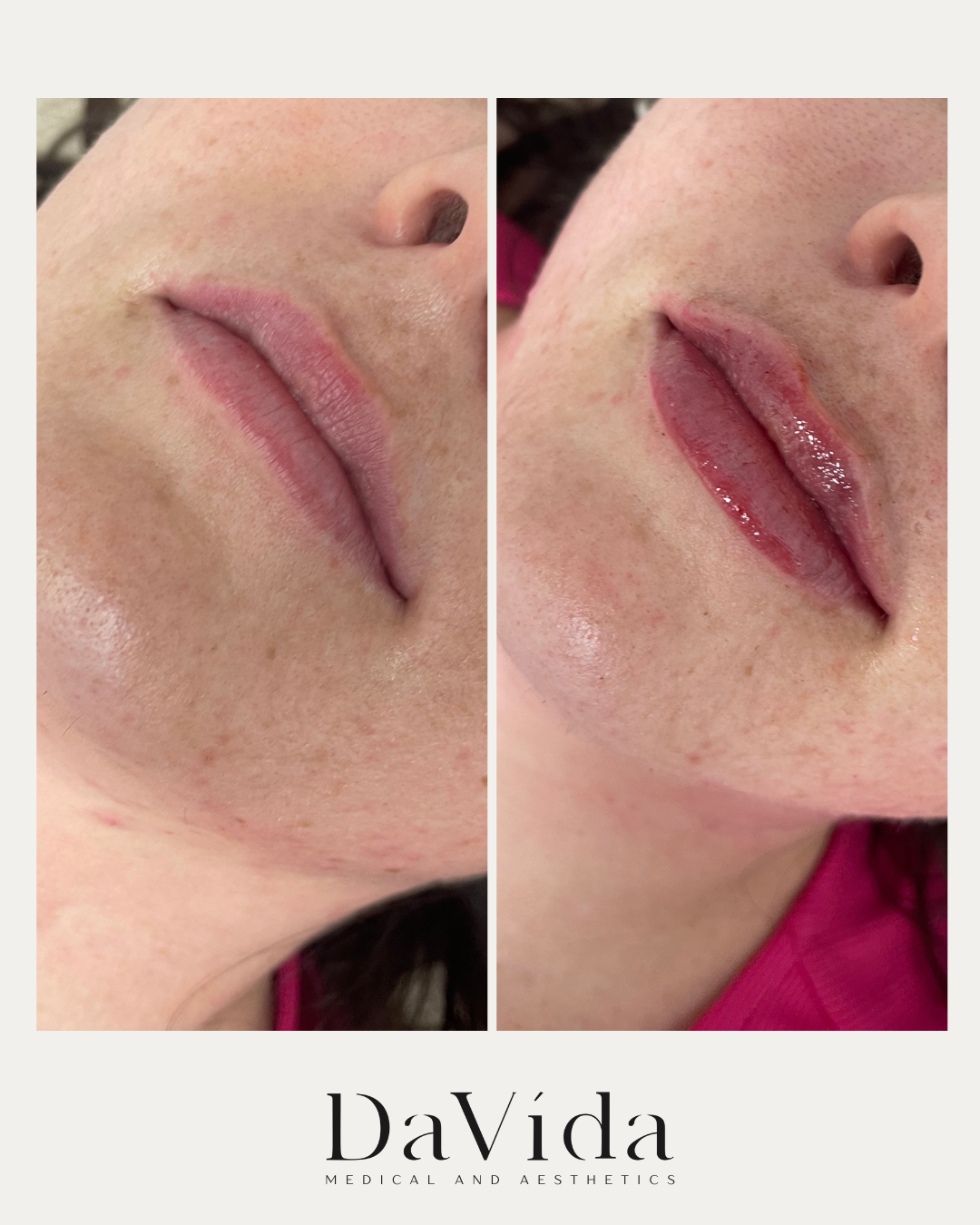 1 Syringe of Juvederm Ultra Results at DaVida
