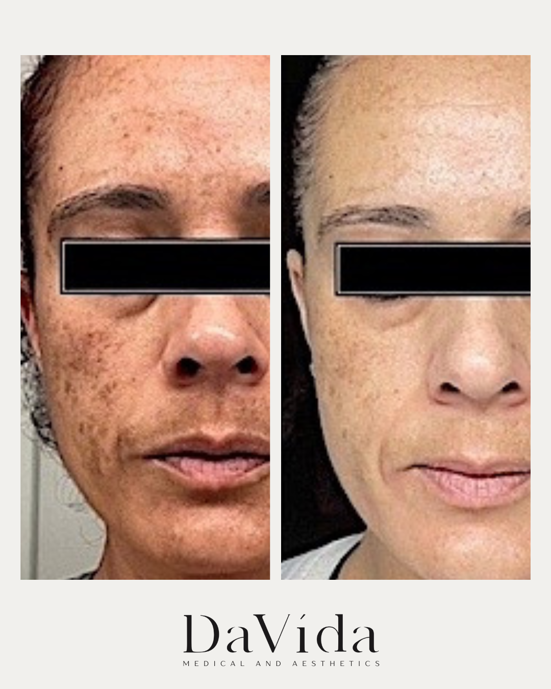 Perfect 10 peel before and after showing brightening