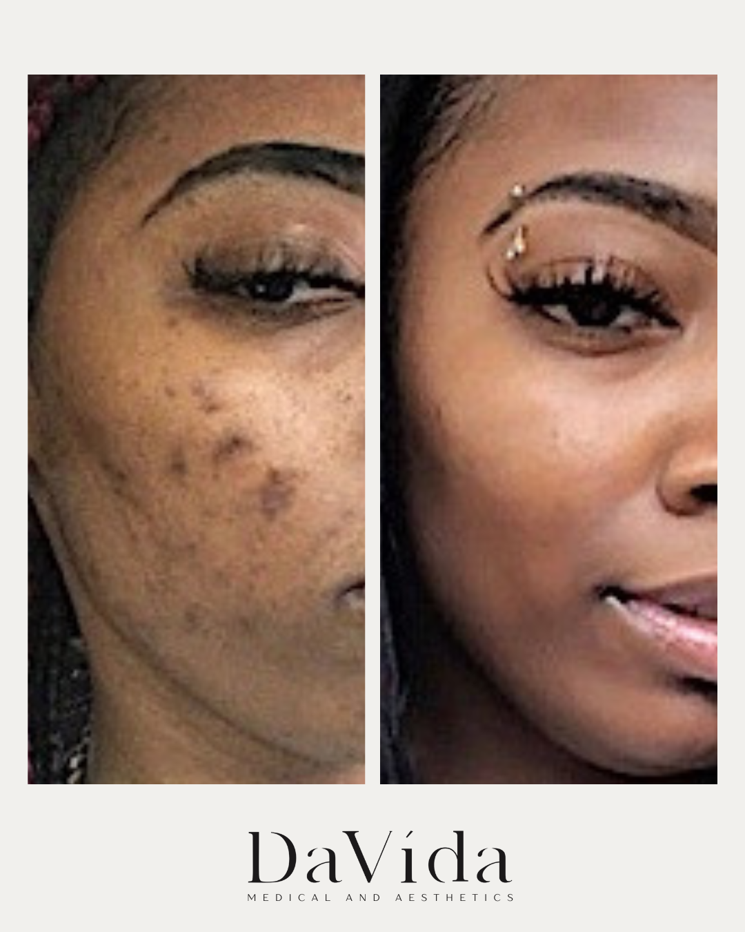 Jessner peel before and after showing clearer skin