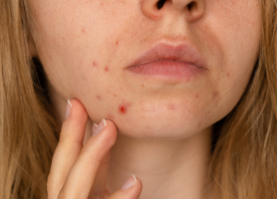 Hyperpigmentation Vs Acne Scars- Whats the Difference?