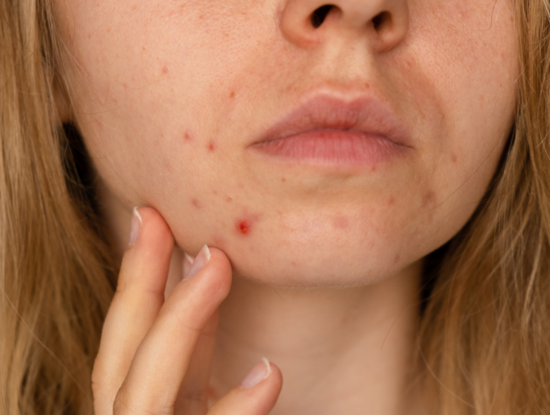 Hyperpigmentation Vs Acne Scars- Whats the Difference?