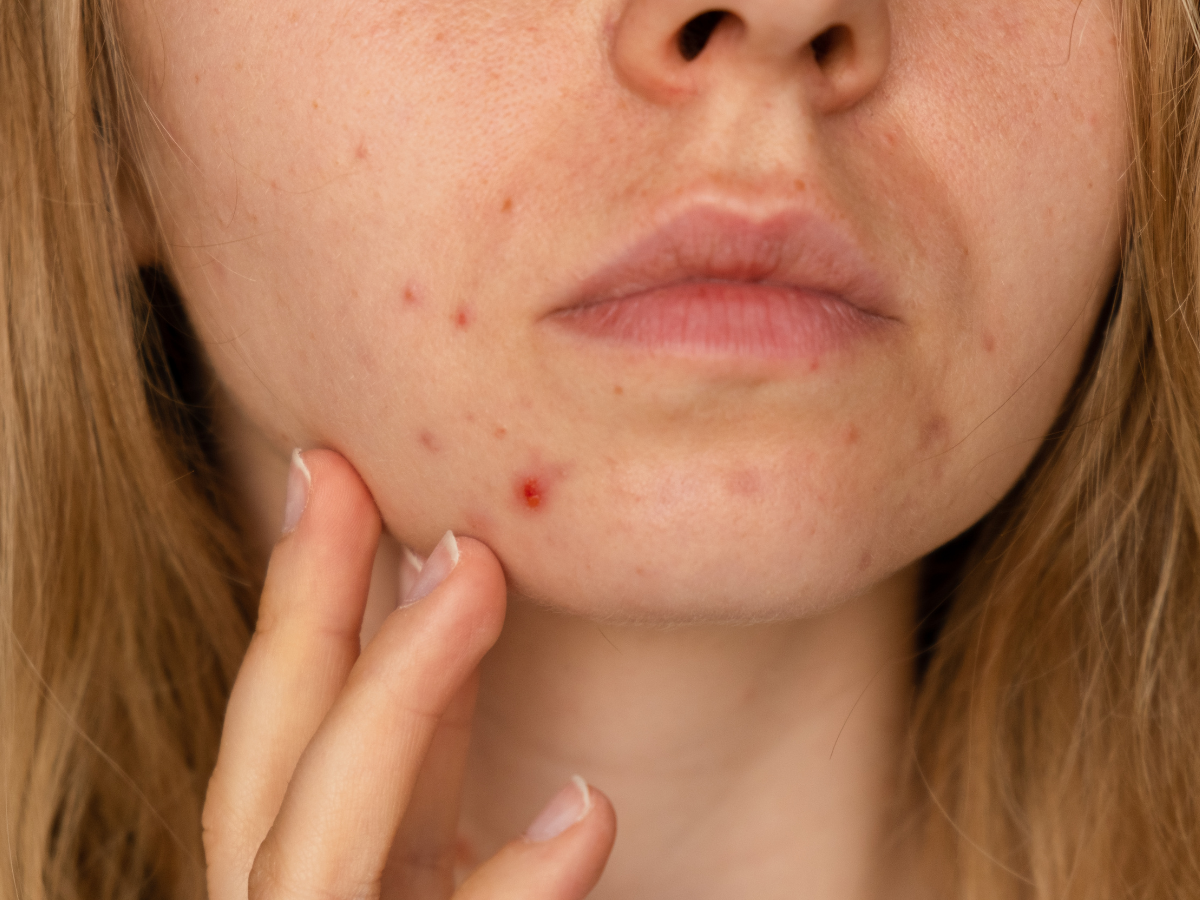Hyperpigmentation Vs Acne Scars- Whats the Difference?