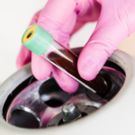 10 PRF Benefits: Why Platelet-Rich Fibrin Is the Future of Natural Skin Rejuvenation