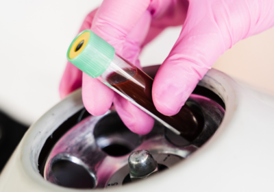 10 PRF Benefits: Why Platelet-Rich Fibrin Is the Future of Natural Skin Rejuvenation