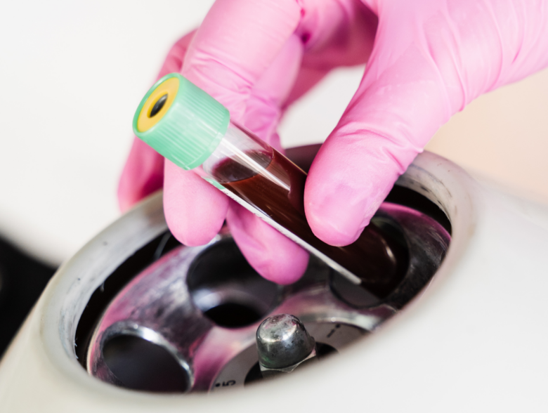 10 PRF Benefits: Why Platelet-Rich Fibrin Is the Future of Natural Skin Rejuvenation