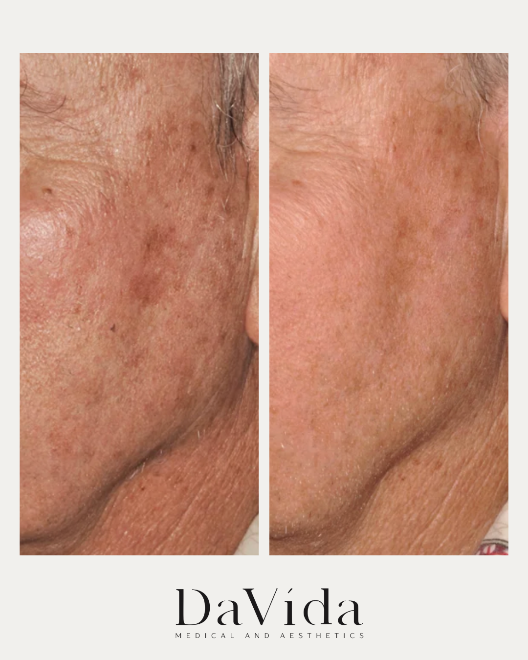 IPL photofacial treatment results on the face
