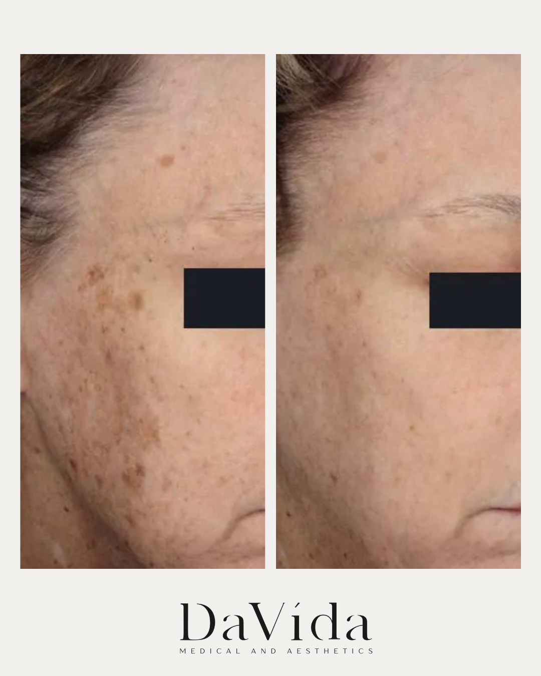 Erbium laser resurfacing before and after on the skin