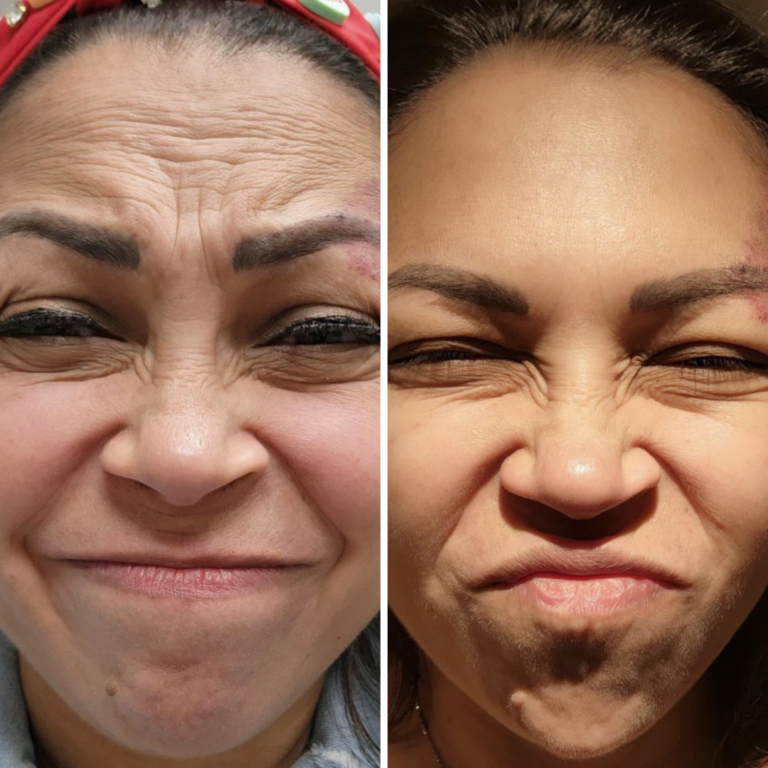 100 Units of Wrinkle Relaxers