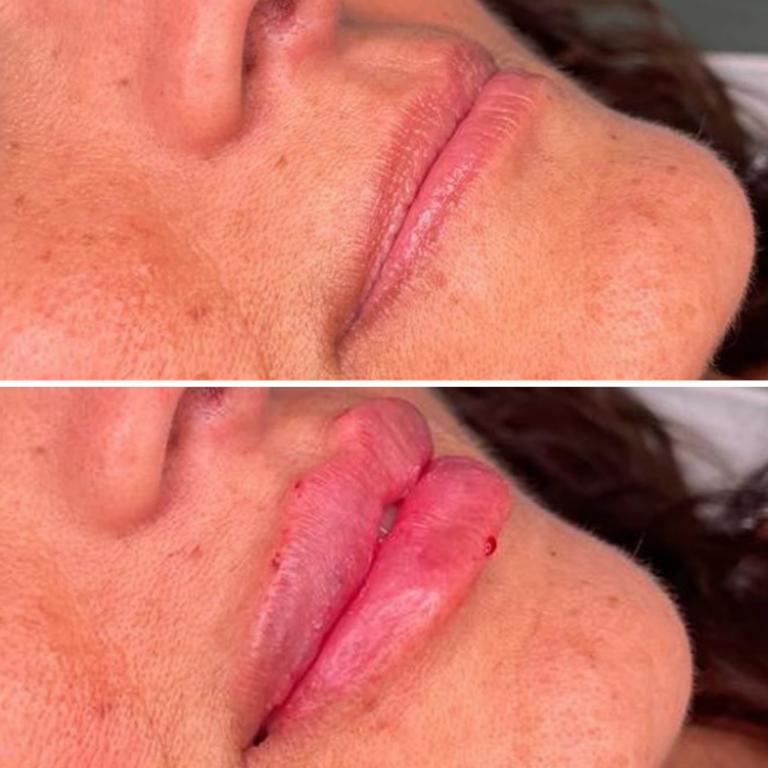 2 Syringes Lip Filler