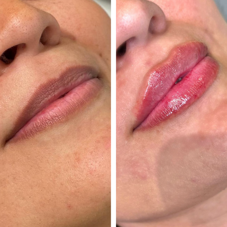 1 Syringe Lip Filler