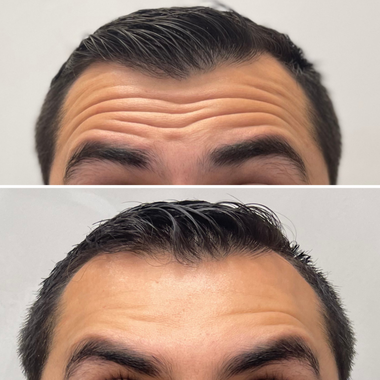 20 Units of Wrinkle Relaxers