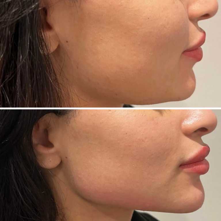 2 Syringes Lower Face Filler