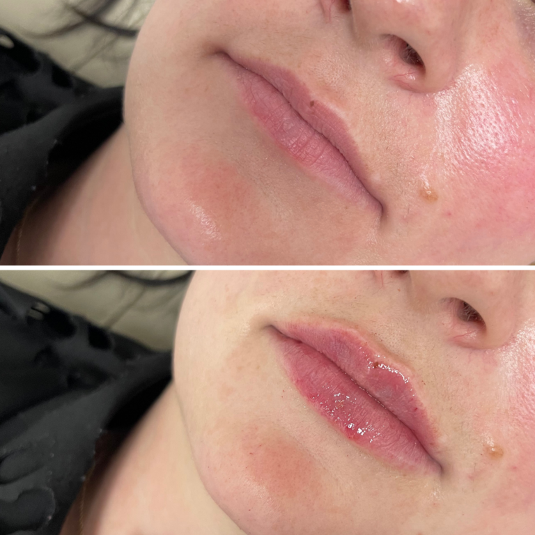 1 Syringe Lip Filler