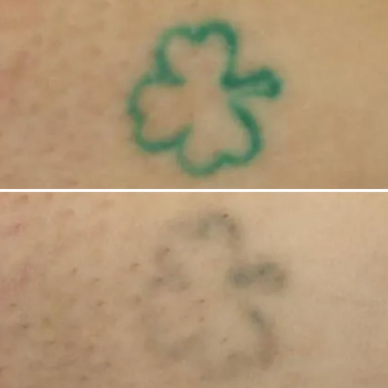 10 Sessions Laser Tattoo Removal