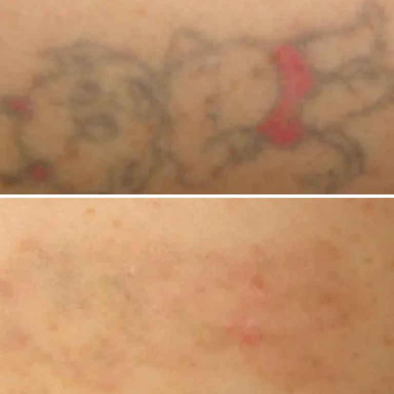 6 Sessions Laser Tattoo Removal