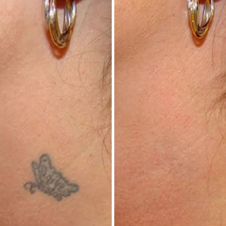 12 Sessions Laser Tattoo Removal