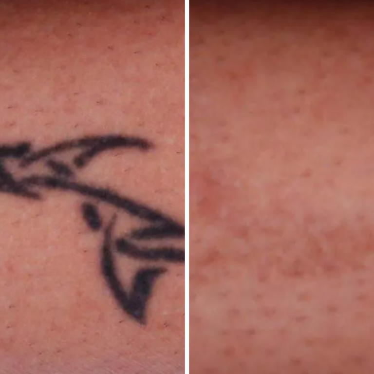 10 Sessions Laser Tattoo Removal