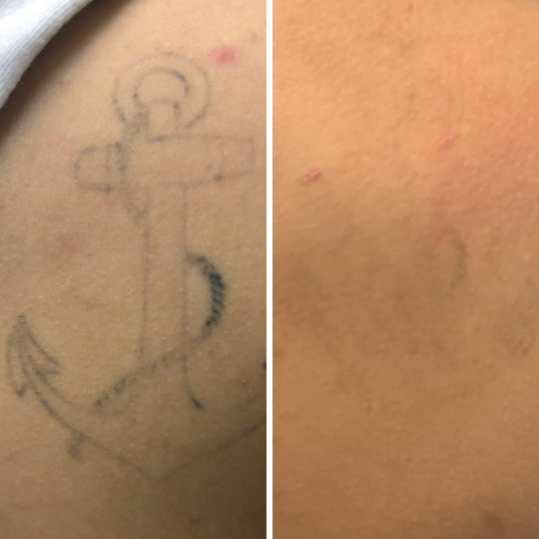 6 Sessions Laser Tattoo Removal