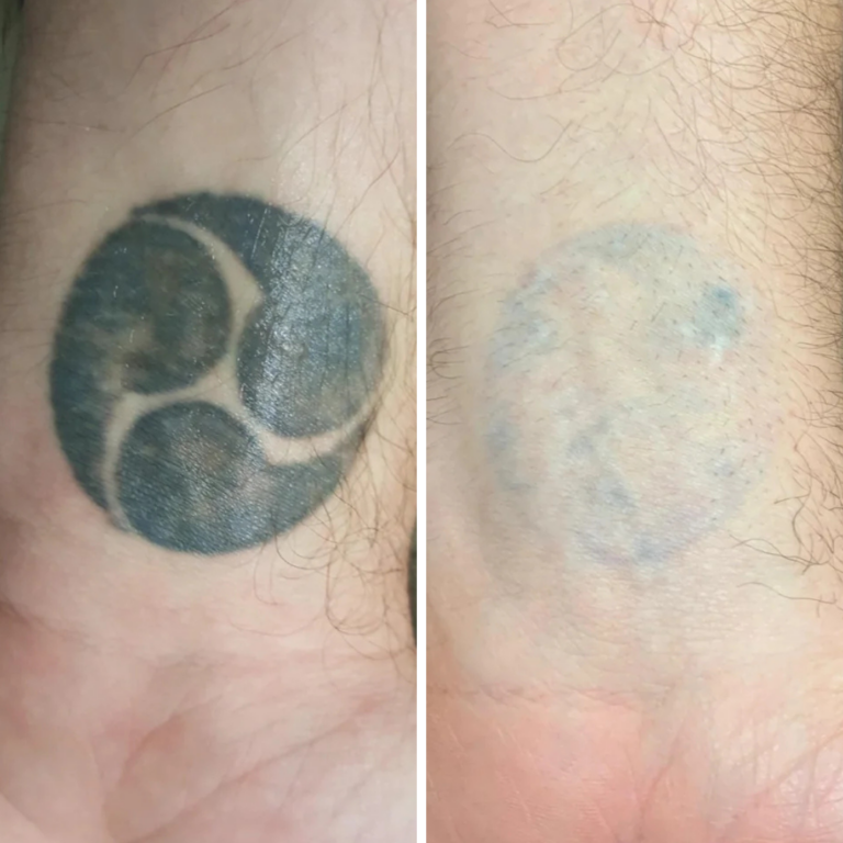 8 Sessions Laser Tattoo Removal