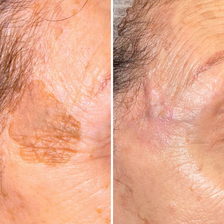 3 Sessions Brown Spot Removal