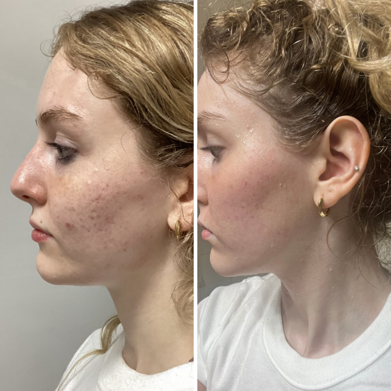 1 Session Laser Skin Resurfacing