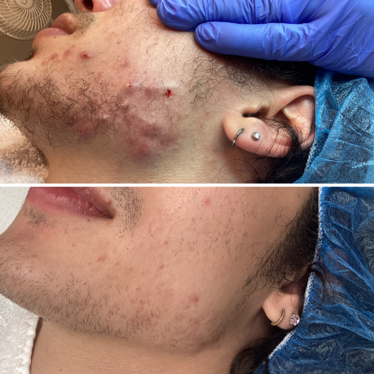 3 Sessions Targeted Acne Treatments