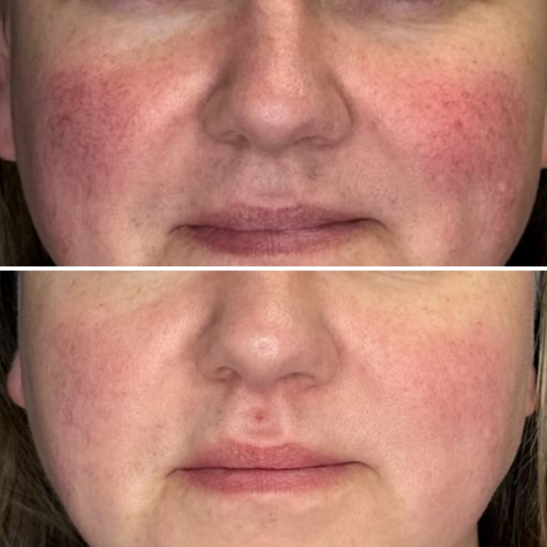 3 Sessions IPL Photo Facial