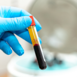 Blood draw for PRF treatment as part of a prf vs prp under eyes procedure