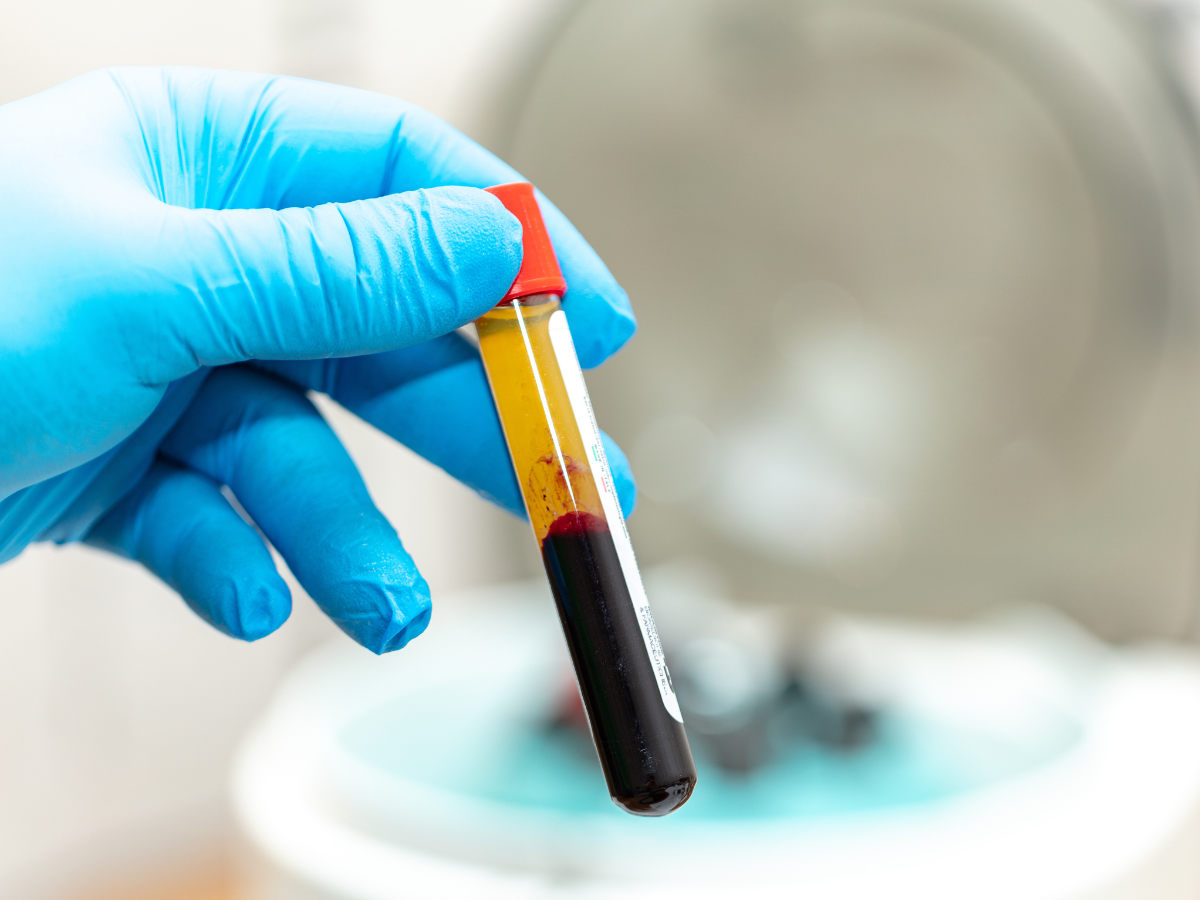 Blood draw for PRF treatment as part of a prf vs prp under eyes procedure