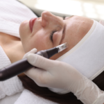 Woman receiving microneedling treatment during microneedling vs vampire facial skin rejuvenation procedure to improve texture and collagen