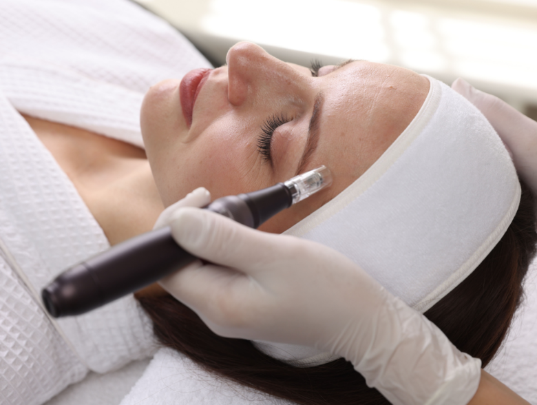 Woman receiving microneedling treatment during microneedling vs vampire facial skin rejuvenation procedure to improve texture and collagen