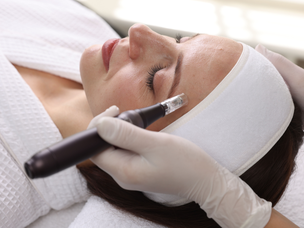 Woman receiving microneedling treatment during microneedling vs vampire facial skin rejuvenation procedure to improve texture and collagen