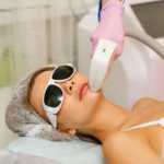 Patient receiving laser skin resurfacing treatment during erbium laser vs CO₂ laser consultation comparison