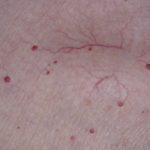 Skin showing cherry angioma vs spider angioma with raised red spots and branching visible blood vessels